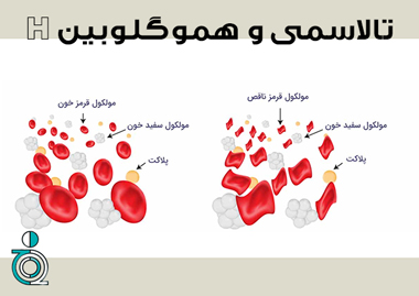 تالاسمی و هموگلوبین H